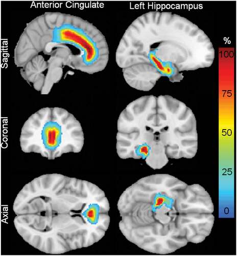 Figure 4. Probabilistic map of finding the bilateral anterior cingulate gyrus and left hippocampus. Colorbar represents 0 to 100% probability.