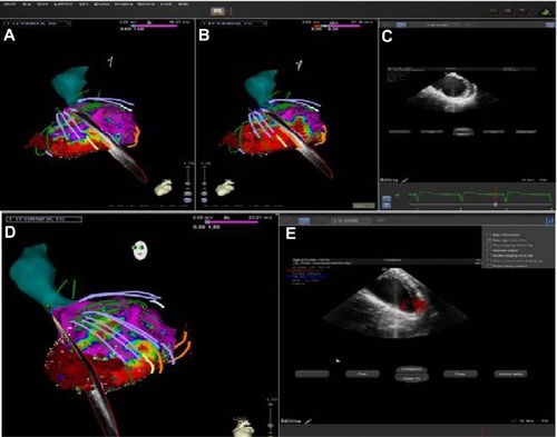 Figure 6 Integration of intracardiac echocardiography with ventricular electronanatomic mapping.