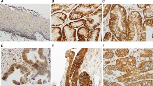 Figure 2 High expression of TGR5 in various histologic subtypes assessed via immunohistochemical studies.Notes: (A) TGR5 positive cells (score 2+ in most cells) predominately distributed in the basal layer of normal esophageal squamous epithelium; (B) TGR5 strongly positive cells evenly distributed in the glands of columnar cell metaplasia; (C) TGR5 strongly positive cells evenly distributed in the glands of Barrett’s esophagus; (D) TGR5 strongly positive cells evenly distributed in low-grade dysplasia glands; (E) TGR5 strongly positive cells evenly distributed in high-grade dysplasia glands; (F) TGR5 strongly positive cells evenly distributed in EAC glands. Magnification (A) 200× and (B–F) 400×.