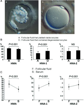 Figure 1.  A) A degenerated oocyte (a) and a morphologically normal oocyte (b). B) A comparison of the mean redox states of follicular fluid albumin that yielded morphologically normal oocytes and degenerated oocytes. HMA and HNA-1 of FF that contained degenerated oocytes were significantly shifted to the oxidized state compared with those of the FFs that yielded morphologically normal oocytes. However, there was no significant difference in NHA-2(HMA; P < 0.001, HNA-1; P < 0.001, HNA-2; NS). C) A comparison of the mean redox state of follicular fluid albumin and the corresponding sera. HMA, HNA-1 and HNA-2 in FF were all significantly reduced compared with those in serum (HMA; P < 0.001, HNA-1; P < 0.001, HNA-2; P < 0.001). HMA: human mercaptalbumin; HNA: human nonmercaptalbumin; FF: follicular fluid.