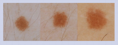 Figure 13. Evolving Spitz nevus.At baseline this nevus revealed a starburst pattern. The lesion was re-imaged at a 6-month follow-up appointment and another image was obtained at 2-year follow-up. The starburst pattern had transformed into a homogeneous pattern.