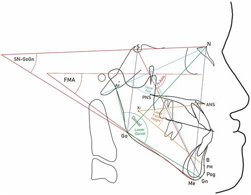 Figure 1 Anatomical lines and angles used in this study to determine vertical dysplasia and growth of the nasomaxillary and mandibular complexes in the vertical direction.