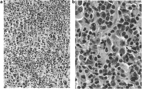 Figure 2. Photomicrograph showing inflammatory response in subcutaneous metastasis. The clinically inflamed tumor was excised 5 months after beginning treatment with DNP-vaccine. (a) (200×) the tumor tissue is intensely infiltrated with lymphocytes. (b) (600×) Necrosis of individual tumor cells is apparent (arrow).
