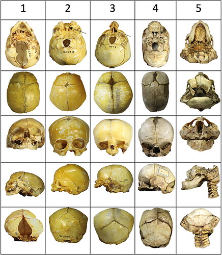 Figure 3. An overview of the five perinatal crania is analyzed from row 1 to row 5. Two crania have mandibular bones, and three do not have mandibular bones. Each cranium is demonstrated from top to bottom in the cranial base view, the thecal view, the anterior view, the lateral view, and the posterior view. Cranium 1, Row 1: A large malformation (absence of occipital bone), marked green in Figure 2, is observed in the occipital view. In the thecal view, the absence (or early closure) of fontanel is apparent. In the frontal view, a low appearance of the diminutive frontal bones appears. In the posterior view, an absence of bone appears below the lambdoid suture. Cranium 2, Row 2: Absence of bone in the middle of the face (yellow area in Figure 2) and presence of septum nasi (arrow) appear in the occipital view. In the thecal view, a diminutive frontal fontanel appears. In the frontal view, the mid-axial cleft does not affect the orbital structures. In the lateral view, a short arcus zygomaticus can be observed. In the posterior view, an extra triangular bone appears above the occipital squama. Cranium 3, Row 3: In this cranium, only the mid-axial part of the face appears (this is the yellow part that was missing in Cranium 2). The regions present are the red and orange fields in Figure 2. The nasal septum is marked by an arrow. In the thecal view, the fontanel appears normal. In the frontal view, the cavum nasi appears diminutive, and the lower rim of the orbita is absent. In the lateral view, the zygomatic bone and the arcus zygomaticus are missing. Cranium 4, Row 4: A narrow and long cranium appears from the occipital view. The absence of zygomatic bone and arcus is observed (orange areas in Figure 2). In the thecal view, the posterior part of the parietal bones is fused (synostosis). In the anterior part, the interfrontal bones are separated by a broad suture. Irregularities in the suture system also appear in the posterior view. Cranium 5, Row 5: In the occipital view, the palate appears narrow posteriorly. From the thecal view, parts of the frontal bone are visible anteriorly, and parts of the occipital bone are visible in the posterior direction. There is no thecal bone (purple area in Figure 2) uniting these two parts of the skull. In the frontal view, a narrow interocular distance is observed. In the lateral view, the maxillary complex appears diminutive and retrognathic. In the posterior view, there appear to be fusions between the cervical vertebrae. Bilateral malformations in the lower part of the occipital squama are observed.