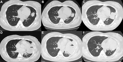 Figure 1 Chest computed tomography (CT) findings. (A) Chest CT showing a round nodule-like shadow in the left upper lobe, with a clear boundary and shallow lobule of about 2.5 cm diameter. (B) After anti-infection treatment, the chest CT showed a high-density shadow in the tongue segment of the left lung, with a size of about 3.2 cm * 2.7 cm, likely to be neoplastic. (C) Chest CT showing a 5.3 cm * 3.5 cm tumor mass in the lingual segment of the left upper lobe. (D) The lesion in the left upper lobe was about 9.1 cm * 6.7 cm, with bubbles and liquid dark areas. After enhanced CT, the lesion showed circular enhancement. (E) Chest CT showing a mass of 8.8 cm * 8.0 cm in the upper lobe of the left lung, containing gas-liquid plane. (F) Chest CT showing a small nodular high-density shadow in the lower lobe of right lung with clear boundary and 1.2 cm diameter.