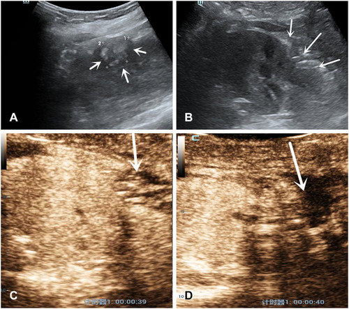 Figure 1 Features of US and CEUS of a patient with a drip spot of the contrast agent extravasation. A 52 years-old woman with a 2.4×2.0cm diameter solid tumor underwent RANSS. (A) Conventional US displayed a hyperechoic mass located in the middle-lower pole of the left kidney before surgery (arrows). (B) On postoperative day 1, conventional US demonstrated the wound as a severe hollow on the renal surface (arrows). (C) On postoperative day 1, in the medullary phase CEUS demonstrated a drip spot of the contrast agent extravasated from the wound to the filling defect which represented the effusion (arrow). (D) The extravasation could not be detected on postoperative day 3 (arrow). A drip spot of the contrast agent extravasation from the wound on postoperative day 2 was the same as that on day 1.
