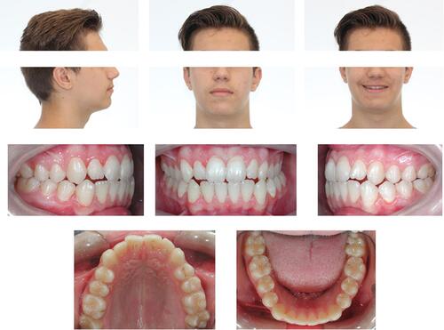 Figure 1 Clinical case 1: initial pictures of face and intraoral images.
