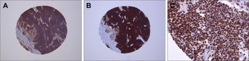 Figure 2 Tissue microarray immunohistochemistry.