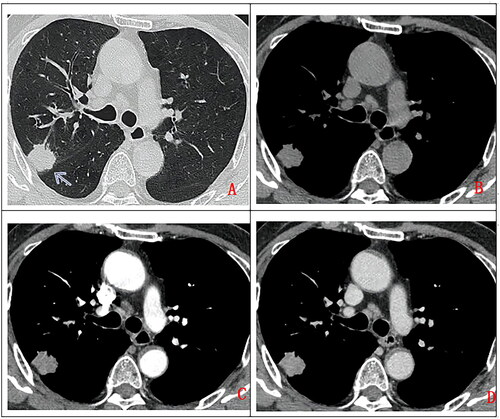 Figure 4. A 68-year-old man, with no clinical symptom had chest CT scan without contrast (A. lung window, B. mediastinum window) and with contrast (A. artery phase, B. Delay phase). a solitary subpleural pulmonary nodule in right upper lobe (as indicated by arrow), with lobulated margin, uniform density, moderate enhancement on contrast enhancement CT. Pathologically confirmed high-grade mucoepidermoid carcinoma after surgical operation.