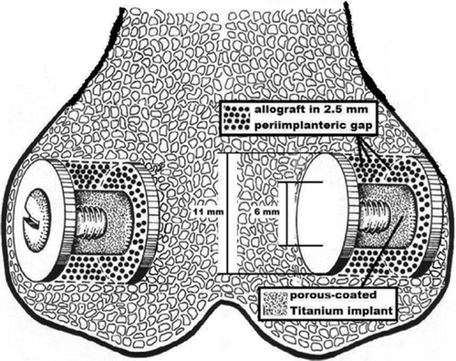 Figure 1. Distal femur with a gap implant in each epicondyle. Morselized allograft was packed into the 2.5-mm gap around the implants prior to mounting of the top washers.