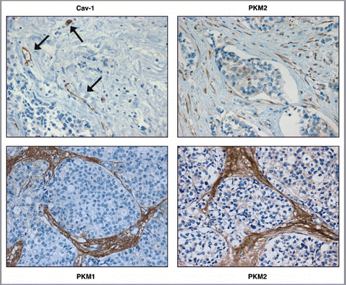Figure 1 PKM1 and PKM2 are highly expressed in the tumor stroma of human breast cancer samples lacking stromal Cav-1. Human breast cancer samples were immuno-stained with antibodies against Cav-1, PKM1, and PKM2. Antibodies directed against PKM1 and PKM2 are isoform-specific. Upper left panel: a representative example of a loss of Cav-1 staining in stromal cells is shown. Loss of Cav-1 expression occurs selectively in cancer-associated fibroblasts, but Cav-1 expression is retained in endothelial cells. Arrows indicate Cav-1 positive vessels. Right panels: PKM2 staining was performed using two different antibodies on human breast cancers lacking stromal Cav-1. Note that PKM2 expression is increased in the tumor stroma and displays two expression patterns. Upper right: PKM2 expression (detected with a Cell Signaling antibody) is largely confined within the stromal cells. Lower right: PKM2 (detected with a Proteintech antibody) can be also detected in the extracellular matrix of human breast cancers. Lower left panel: note that PKM1 is also upregulated in the stroma of human breast cancer samples lacking stromal Cav-1. Original magnification for all, 40×.