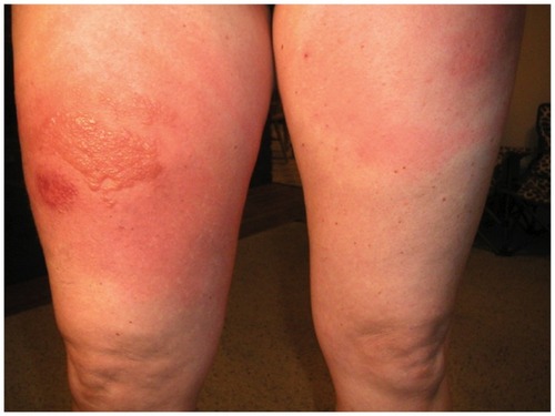 Figure 1 Patient on ipilimumab who experienced itching and rash over more than 75% of her body.Notes: The event was resolved by treatment with steroids followed by a slow steady taper over one month. Photo courtesy of Jeffrey Weber MD, PhD.