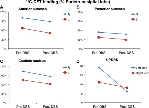 Figure 2 (A–C) Pre-DBS and post-DBS plots demonstrating progressive bilateral decreases (percentage relative to parieto-occipital reference) of post-DBS 11C-CFT dopamine transporter binding in the anterior putamen (A), posterior putamen (B) and caudate (C) after one year. Stimulation was performed on the right side. (D) The UPDRS score for the left limbs was similar to that of the right limbs before and after DBS.