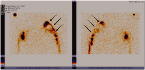 Figure 6. Lymphoscintigraphy, performed 11 years after grafting clearly shows lymph flow along the route of patent lymphatic grafts from the left arm to the neck (arrows). Left, frontal view; right, dorsal view.