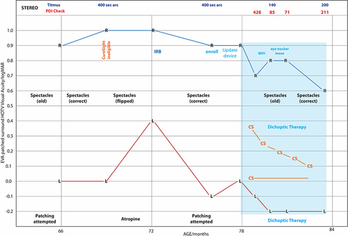 Figure 1 Time course of prior and dichoptic amblyopia therapy including spectacle-flip sabotage while on atropine for anisometropia therapy.