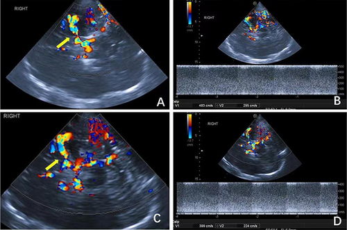 Figure 2 Patient with Asymptomatic cerebral carotid artery stenosis in the Secondary Prevention Combined compound dilong capsules. (A and B) at baseline. (C and D) after treatment. (A) CDFI image showing stenosis of the right MCA (yellow arrow). (B) Color Doppler spectrum showing that the PSV at stenosis increased by 483 cm/s. (C) CDFI image of the same patient after treatment showing that the stenosis of the right MCA improved compared with the baseline (yellow arrow). (D) Color Doppler spectrum of the same patient after treatment showing that the PSV at the stenosis was reduced to 399 cm/s.
