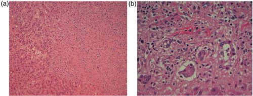 Fig. 3 (a) Liver biopsy showing diffuse infiltration of liver by lymphoma cells with disruption of hepatic architecture and necrosis. (b) Liver biopsy showing hepatocellular necrosis and malignant infiltrate of lymphoma cells.
