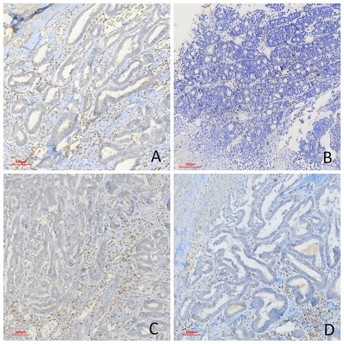 Figure 2. Immunohistochemical PMS2, MLH1, MSH2, and MSH6 study in four different colorectal carcinoma cases. (A) Diffuse loss of MLH1 expression, (B) Diffuse loss of nuclear MSH2 expression, (C) Diffuse loss of nuclear MSH6 expression, (D) Diffuse loss of nuclear PMS2 expression in dMMR cases (immunoperoxidase, 100×) Scale bar = 500 µm.