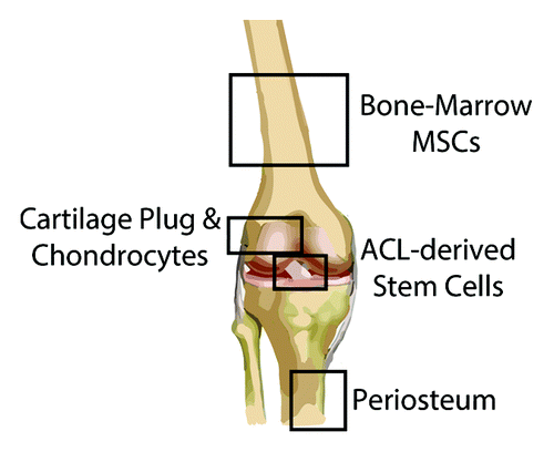 Figure 3. Cell sources for augmenting bone-tendon healing. Animal studies exploring the use of MSCs to improve bone-tendon healing have derived these cells primarily from the bone marrow, although other tissues (e.g., adipose) also harbor MSCs (not shown). ACL-derived MSCs can be obtained from the ruptured ligament, while chondrocytes/cartilage plugs can be taken from non-weightbearing articular surfaces. Lastly, the periosteum is typically harvested from the anteromedial tibia, given the ease of access in the absence of overlying soft tissues.