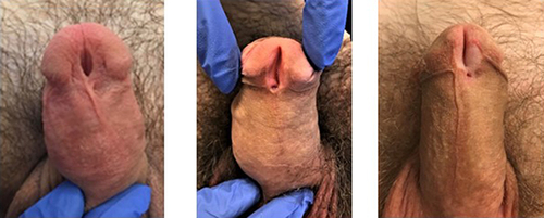 Figure 2 Three representative men with uncorrected hypospadias included in this report. Note that none have glans fusion.