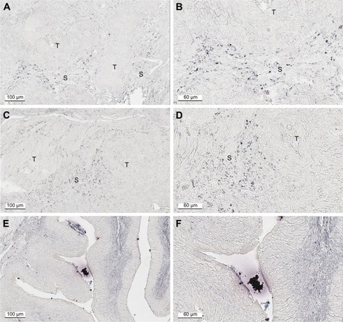 Figure 7 Low background AuNP distribution in bladders from untreated control and BBN-treated mice. (A, B) BBN, 17 weeks; (C, D) BBN, 22 weeks; (E, F) control untreated, 22 weeks.Abbreviations: AuNP, gold nanoparticle; BBN, N-butyl-N-(4-hydroxybutyl)nitrosamine; T, tumor; S, stroma.