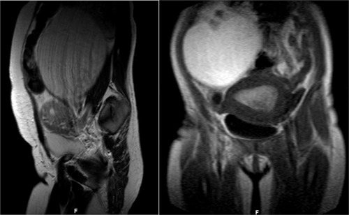 Figure 3 MRI at 6 weeks postpartum.