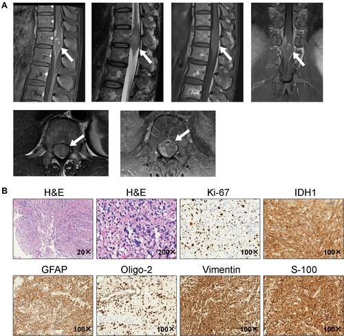 Figure 1 Images of initial MRI examination and pathological diagnosis. (A) Magnetic resonance imaging revealed space-occupying lesion in medullary cone. (B) Hematoxylin and eosin stain of the resected tissue supported the diagnosis of glioblastoma (hypercellularity, nuclear pleomorphism, brisk mitotic activity and multinuclear giant cell). The immunohistochemical results showed that IDH1, GFAP, Oligo-2, p53, and S-100 were expressed and the Ki67 proliferation index was ˜50%.