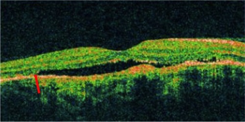 Figure 18 Choroidal hemangioma showing disruption of photoreceptor ISel band, ELM (red arrow) and serous detachment.