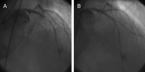 Figure 1.  Coronary angiography demonstrating left anterior descending coronary artery thrombosis (A) successfully treated with angioplasty and stenting (B).