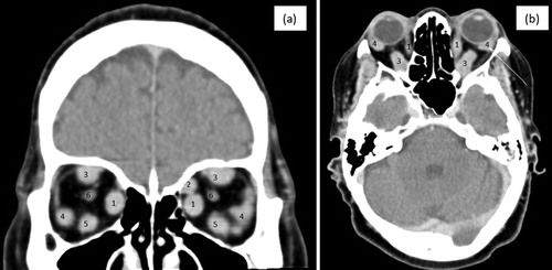 Figure 2: (a) and (b): Coronal and sagittal views of a contrasted brain CT illustrating enlargement and marked contrast enhancement of extraocular muscles (EOM) (inferior (5), medial (1) and superior rectus (3) bilaterally, left lateral rectus (4) and, to a lesser extent, right lateral rectus (4). The superior oblique (2) and optic nerve (6) appeared unaffected.)