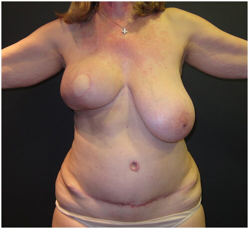 Figure 2. Post-operative view at 6 months following the immediate DIEP flap-based right breast reconstruction; a significant asymmetry is Present, as no symmetrisation surgery was performed on the left breast.