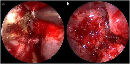 Figure 3. Endoscopic findings showing the right maxillary sinus via the inferior Nasal meatus. (a) The maxillary sinus was filled with fungus balls. (b) Granulation formation was seen at the posterior maxillary wall.