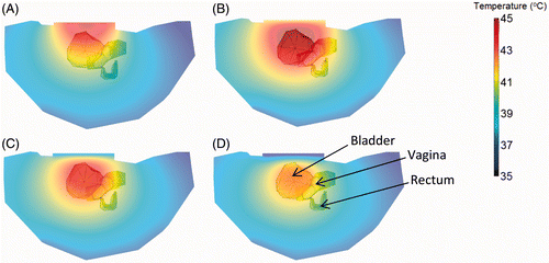 Figure 5. 2D slice temperature profiles in mouse body, bladder, vagina and rectum with bolus temperature (A) unregulated, (B) constant 41°C, (C) constant 38°C and (D) constant 35°C and RF power set at (A) 5 W and (B), (C), (D) 12 W.