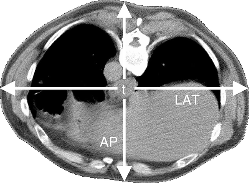 Figure 3. Example of the patient's dorsoventral (AP) and lateral (LAT) diameters, determined from the CT scan in treatment position. The location of the tumour is marked as ‘t’.