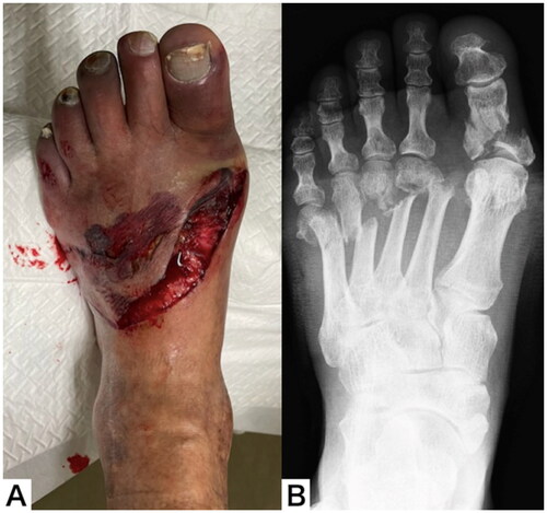 Figure 1. Appearance (A) and plain radiograph (B) of the left foot on Arrival at the trauma center.