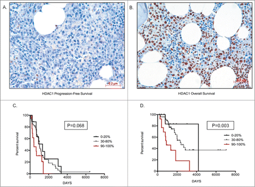 Figure 4. Higher HDAC1 levels correlate with poor prognosis (A) Image depicting low staining of HDAC1 (20%) in MM cells; (B) Image depicting high proportion of HDAC1 staining (90%) in MM cells; (C) Kaplan-Meir survival plots for patients with 0–20%, 30–80%, and 90–100% proportion of HDAC1 staining, indicating patients with higher proportion of HDAC1 have shorter progression-free survival days; (D) Kaplan-Meir survival plots for patients with 0–20%, 30–80% and 90–100% proportion of HDAC1 staining indicating patients with higher proportion of HDAC1 have shorter overall survival days. Patients with >70% infiltration of MM cells was chosen for image capture. Significant differences and median survival days were calculated utilizing GraphPad Prism 5.0d and p-values are indicated.