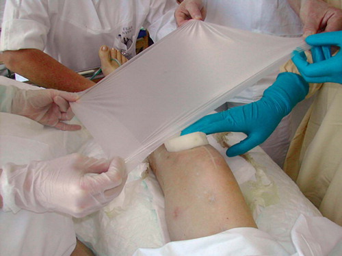 Figure 3. Adhesive drape being applied over the sponge.