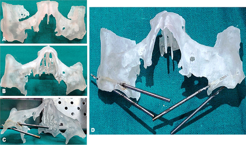 Figure 2 3D printed acrylic models seen from (A) back and (B) front. (C) Mock implant placement on left. (D) Mock implant placement on the right.