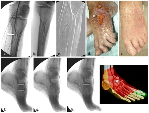 Figure 7 Selective anterior tibial and related dorsalis pedis artery angiosome: (a–c) Primary staged anterior tibial angioplasty, (d) initial dorsal foot ulceration, (e) clinical results at 1 month following (f–h) associated dorsalis pedis selective angioplasty.