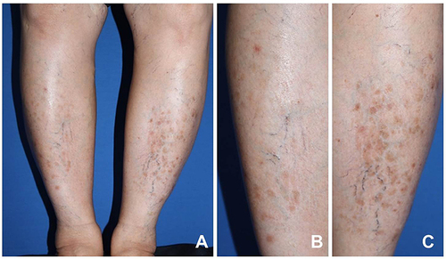 Figure 4 One month after additional oral pentoxifylline, (A) all lesions flattened into patches; close-up pictures of the right (B) and the left legs (C).