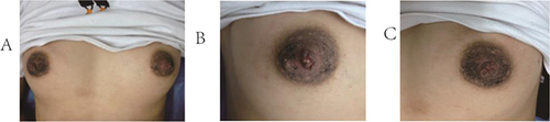 Figure 1 Clinical appearance of the patient on admission. (A) bilateral nipple-areola. (B) left nipple-areola. (C) right nipple-areola.