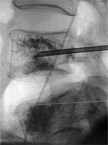 Figure 1. A vertebroplasty performed in the fourth lumbar vertebra of a 67-year-old woman with an osteoporotic fracture.