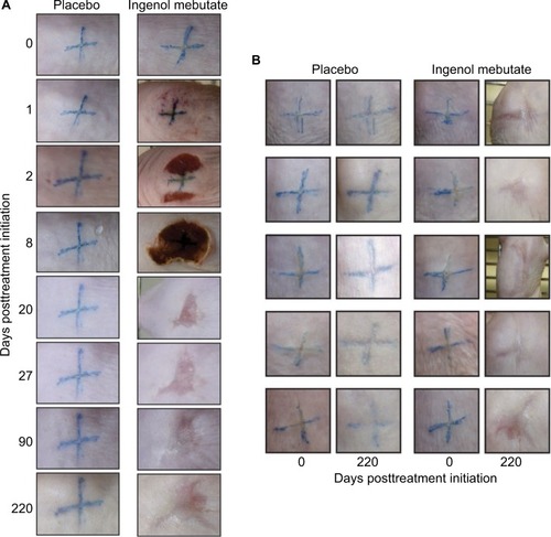 Figure 1 Tattoo removal with ingenol mebutate.Notes: (A) Photographs of two tattoos (≈1 cm × ≈1 cm blue crosses), one treated with placebo and the other with ingenol mebutate, and both followed over time (till Day 220). A fully formed eschar can be seen on Day 8 over the ingenol mebutate-treated tattoo site. (B) Pictures of five tattoos on five mice treated with placebo gel and five tattoos on another five mice treated with ingenol mebutate. Pictures were taken before treatment (Day 0) and 220 days after treatment.