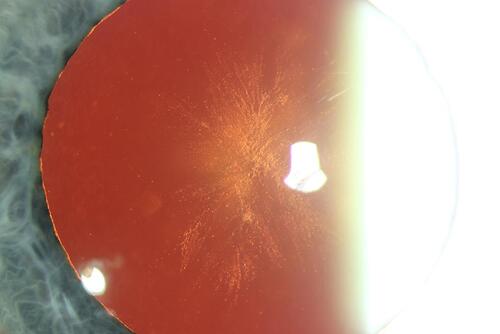 Figure 1 Retroillumination slit-lamp photograph highlighting the anterior subcapsular opacification of the crystalline lens involving the visual axis of the left eye after 18 months of therapy with enfortumab vedotin.