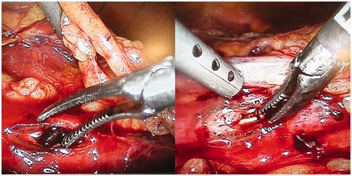 Figure 2. Laparoscopic ureterolithotomy for large and impacted proximal ureteral calculi treatment.