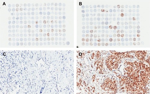 Figure 1 Tissue microarray and immunohistochemistry staining of P-cofilin in invasive ductal breast cancer tumors.