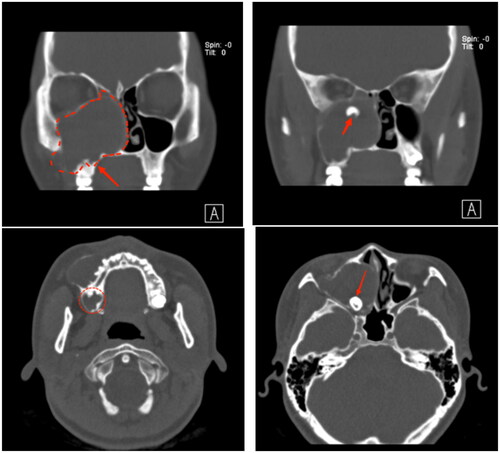 Figure 1. CT of the paranasal sinuses shows a large cystic hypodense lesion visible in the right maxilla, which projects upward and occupies the maxillary sinus to the point where the bone structure of the adjacent sinus wall is significantly thinned and obstructs the right nasal cavity inward, with a tooth visible on top.