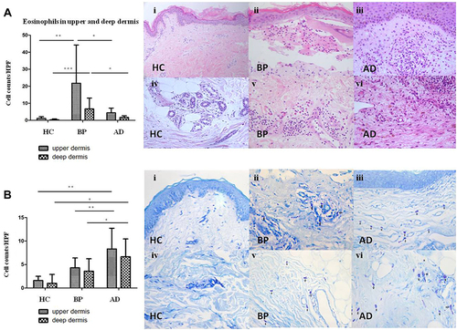 Figure 3 The number of eosinophils and mast cells in upper and deep dermis of BP, AD and normal skin. (A) Eosinophils in upper/deep dermis of HC (Ai/Aiv), BP (Aii/Av) and AD (Aiii/Avi) by histopathology (Aii, Aiii, Aiv, Av, Avi×200, Ai×100). (B) Mast cells in upper/deep dermis of HC (Bi/Biv), BP (Bii/Bv) and AD (Biii/Bvi) by toluidine blue staining. Mast cells were highlighted by black arrows. *P<0.05; **P<0.01; ***P<0.001. (Bii, Biii, Biv, Bv, Bvi×200, Bi×100).