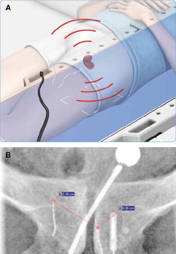 Figure 4A. The treatment table “listen” to the signal from the non-permanent implant and the prostate is localised with sub-millimetre accuracy. The positioning is done continuously with adding more ionisation to the patient (with permission from Micropos Medical, Gothenburg, Sweden). B An implant in the target volume (to the left).