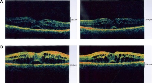 Figure 1 (A) Optical coherence tomography images of the patient’s right and left maculae at the first visit to the King Khaled Eye Specialist Hospital, Riyadh, Saudi Arabia, showing cystic changes and subretinal fluid in both eyes. (B) Optical coherence tomography images of the maculae after multiple treatments consisting of Avastin® and/or triamcinolone acetonide injections, focal and grid laser. Persistent cystic changes and subretinal fluid are present in both maculae.